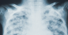 Foto que muestra una radiografia a un torax humano